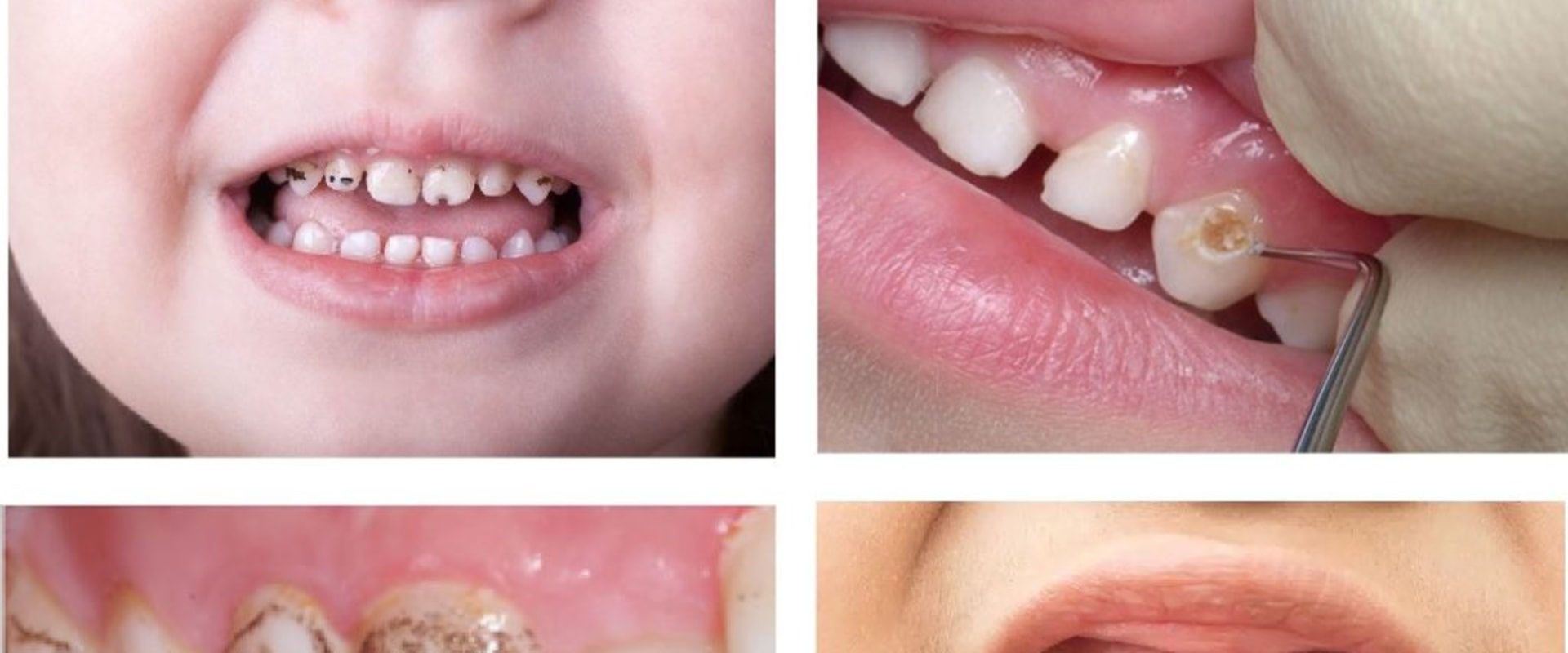 Understanding Cavities and Tooth Decay in Children