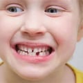 Understanding Teething Problems in Children