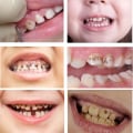 Understanding Cavities and Tooth Decay in Children