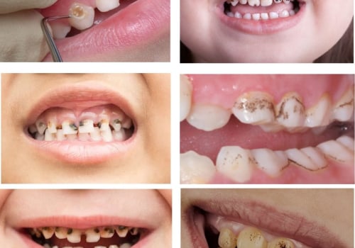 Understanding Cavities and Tooth Decay in Children